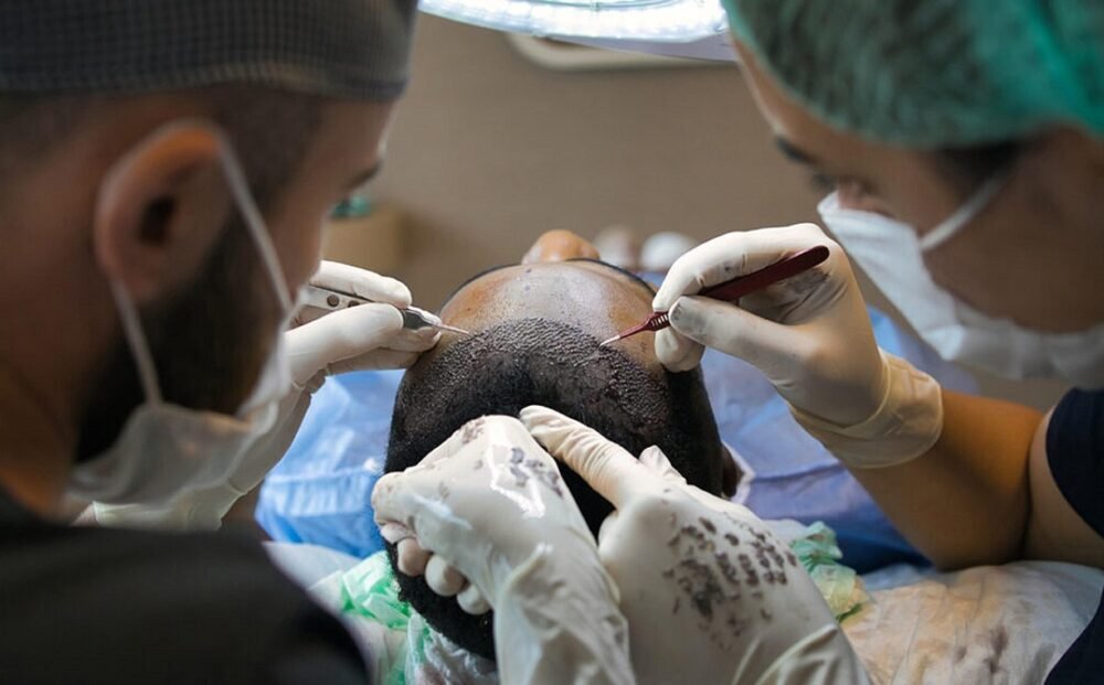 hair-transplant-7518352_1280